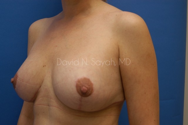 Breast Implant Revision Before and After | Sayah Institute