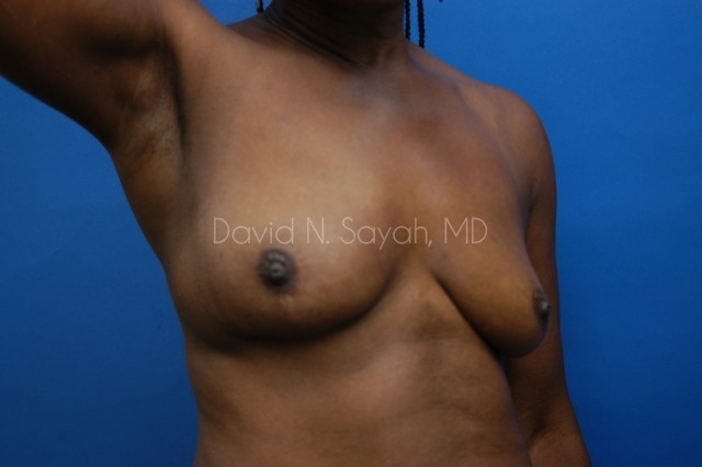 Breast Implant Revision Before and After | Sayah Institute