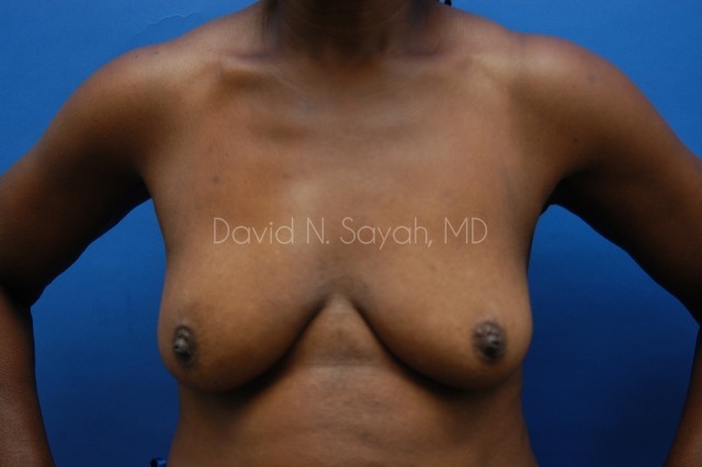 Breast Implant Revision Before and After | Sayah Institute