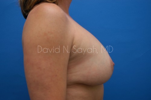 Breast Implant Revision Before and After | Sayah Institute
