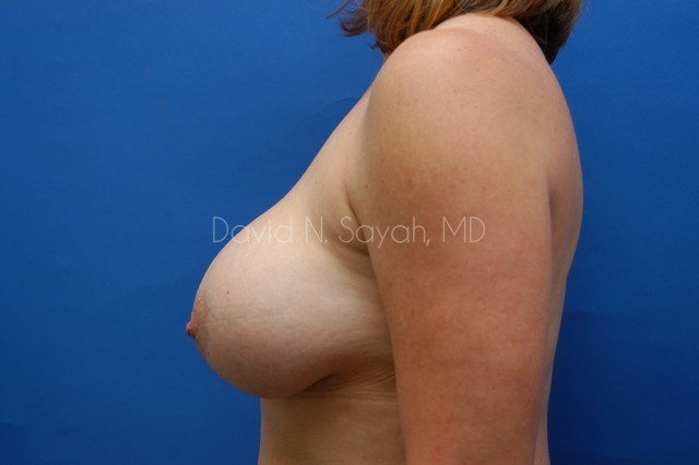 Breast Implant Revision Before and After | Sayah Institute