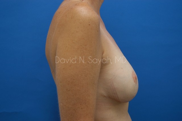 Breast Implant Revision Before and After | Sayah Institute