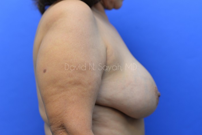 Breast Lift Before and After | Sayah Institute