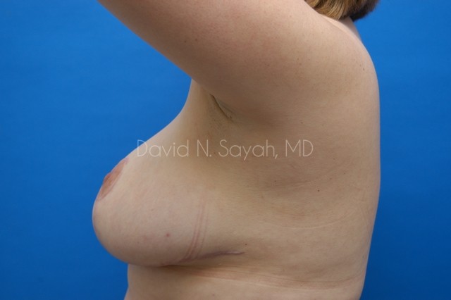 Breast Lift Before and After | Sayah Institute