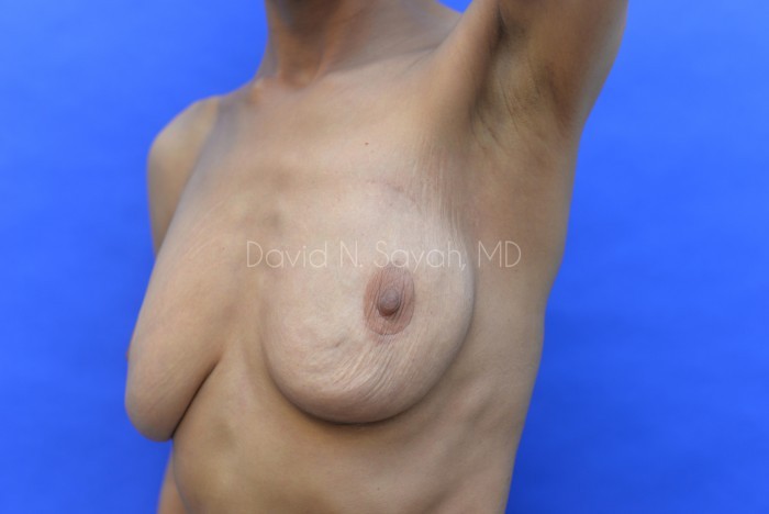 Breast Reconstruction Before and After | Sayah Institute