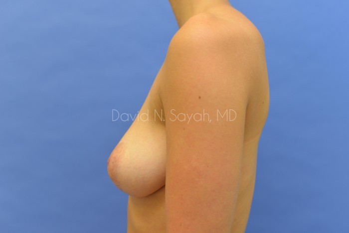Breast Reconstruction Before and After | Sayah Institute
