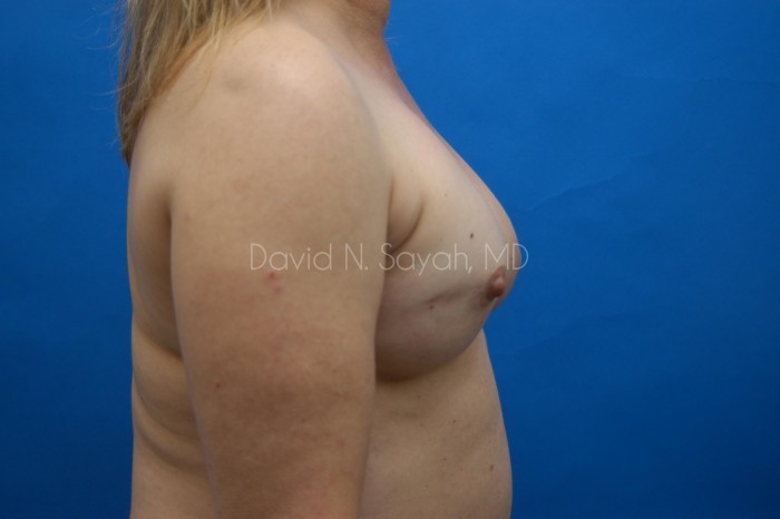 Breast Reconstruction Before and After | Sayah Institute