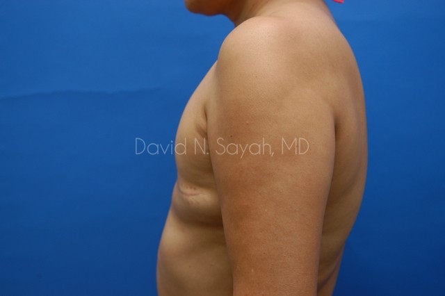 Breast Reconstruction Before and After | Sayah Institute