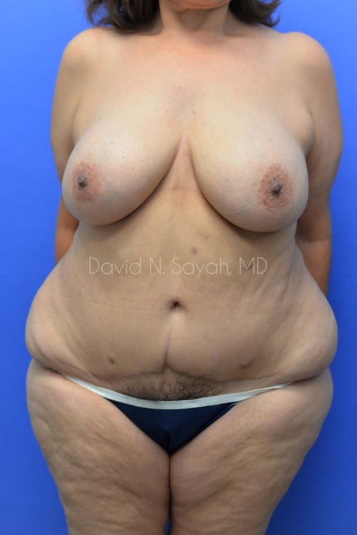 Breast Reduction Before and After | Sayah Institute