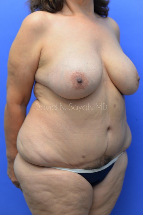 Breast Reduction Before and After | Sayah Institute