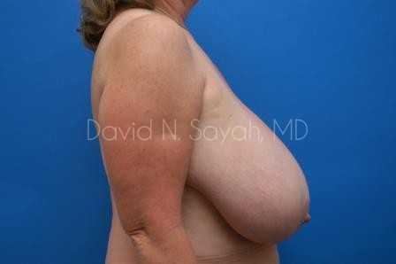 Breast Reduction Before and After | Sayah Institute