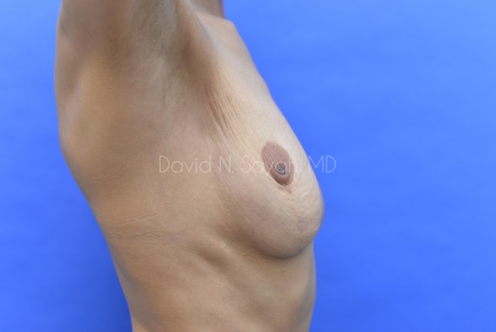 Breast Reduction Before and After | Sayah Institute