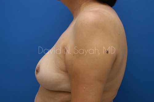 Breast Reduction Before and After | Sayah Institute