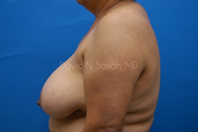 Breast Reduction Before and After | Sayah Institute