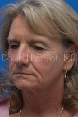 Brow Lift Before and After | Sayah Institute