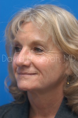 Brow Lift Before and After | Sayah Institute