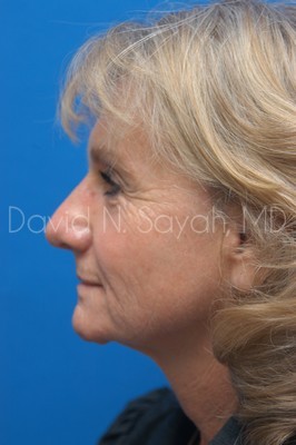 Brow Lift Before and After | Sayah Institute