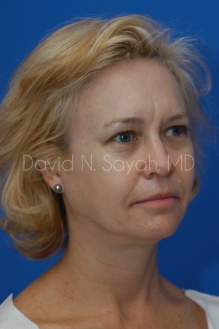 Brow Lift Before and After | Sayah Institute