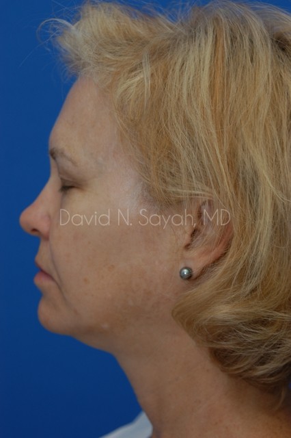 Brow Lift Before and After | Sayah Institute