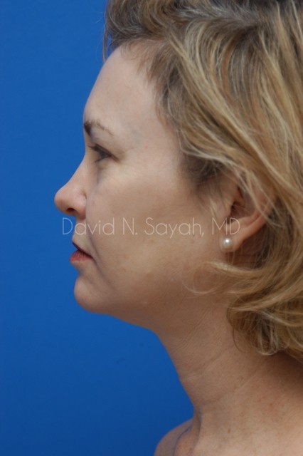 Brow Lift Before and After | Sayah Institute