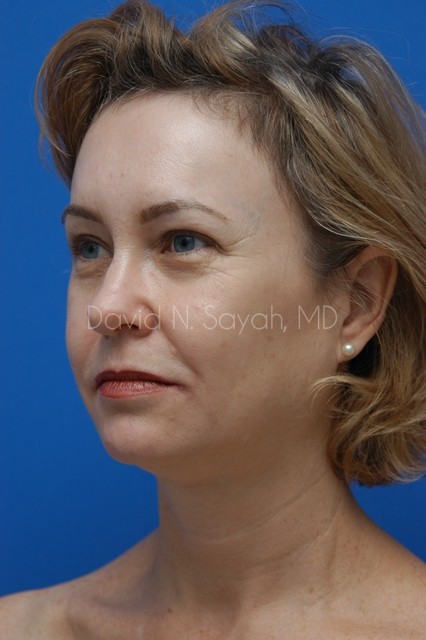 Brow Lift Before and After | Sayah Institute