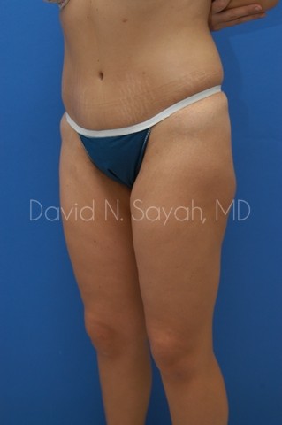 Buttock Lift Before and After | Sayah Institute