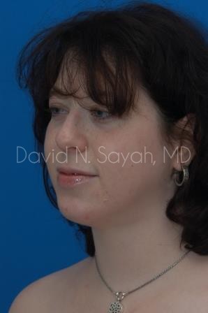 Chin Implant Before and After | Sayah Institute