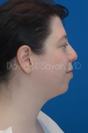 Chin Implant Before and After | Sayah Institute