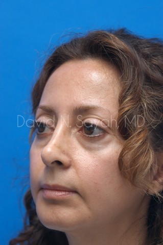 Chin Implant Before and After | Sayah Institute