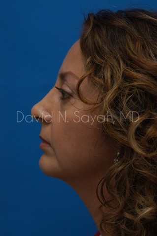 Chin Implant Before and After | Sayah Institute