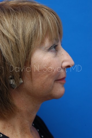 Chin Implant Before and After | Sayah Institute