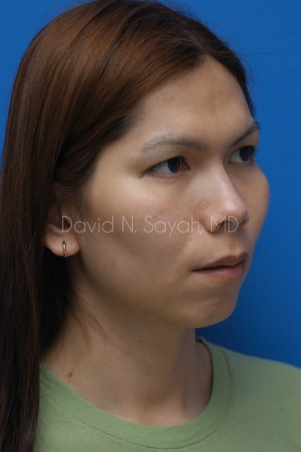 Chin Implant Before and After | Sayah Institute