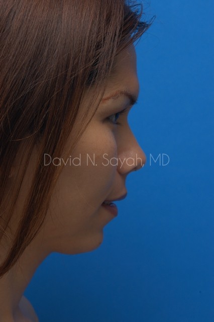 Chin Implant Before and After | Sayah Institute