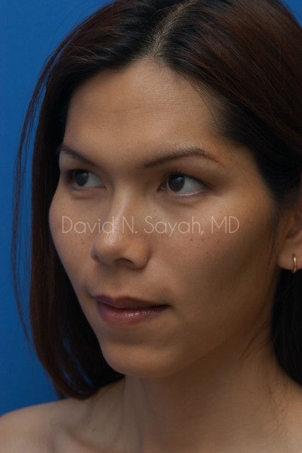 Chin Implant Before and After | Sayah Institute