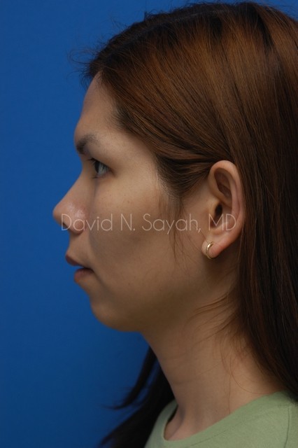 Chin Implant Before and After | Sayah Institute