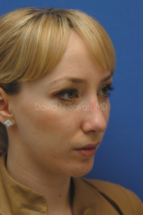 Chin Implant Before and After | Sayah Institute
