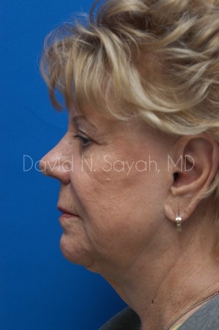 Chin Implant Before and After | Sayah Institute