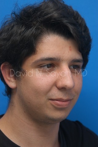 Chin Implant Before and After | Sayah Institute