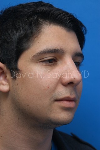 Chin Implant Before and After | Sayah Institute