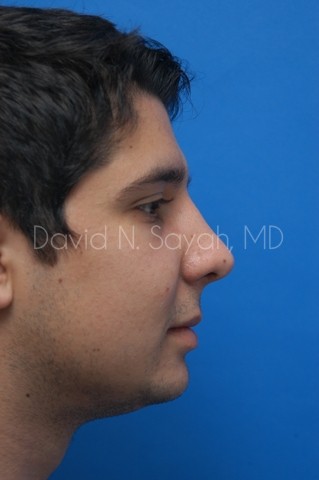 Chin Implant Before and After | Sayah Institute