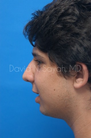 Chin Implant Before and After | Sayah Institute