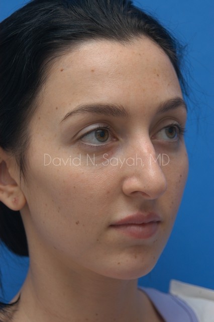 Chin Implant Before and After | Sayah Institute