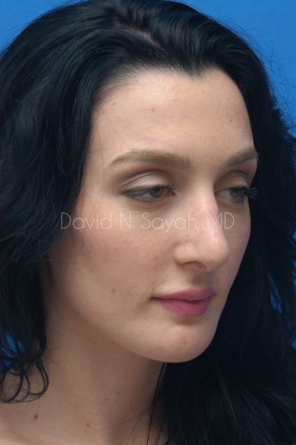 Chin Implant Before and After | Sayah Institute