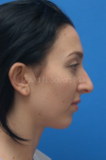 Chin Implant Before and After | Sayah Institute