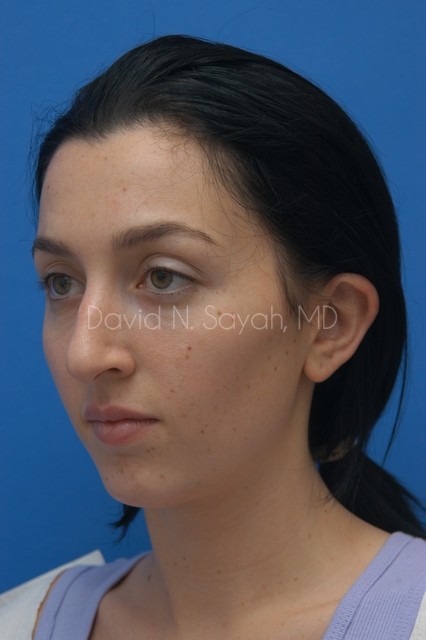 Chin Implant Before and After | Sayah Institute
