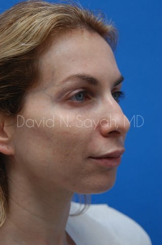 Chin Implant Before and After | Sayah Institute