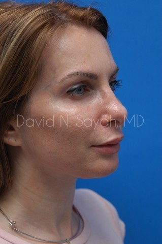 Chin Implant Before and After | Sayah Institute