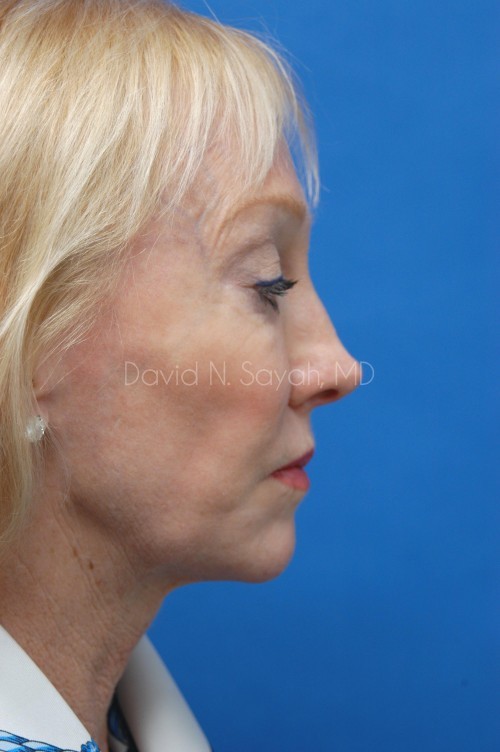 Co2 Laser Before and After | Sayah Institute