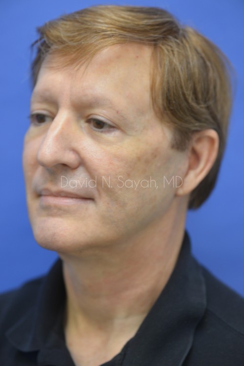 Co2 Laser Before and After | Sayah Institute