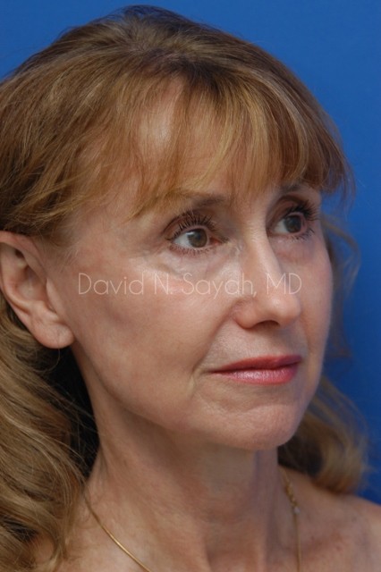 Co2 Laser Before and After | Sayah Institute